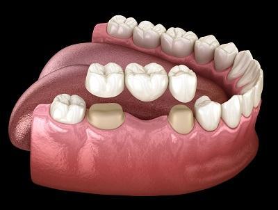 model of dental bridge l dental bridge doylestown pa