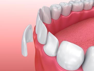 illustration close up of porcelain veneer l Cosmetic Dentist Doylestown PA