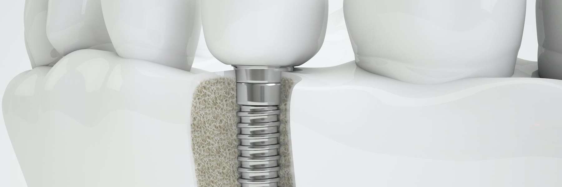 First premolar dental implant of lower jaw in Doylestown PA