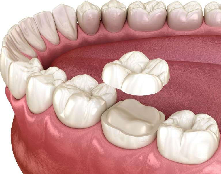 Ceramic onlay on tooth model in Doylestown PA