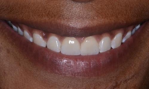 image of the same teeth after crowns and bridge | Doylestown PA