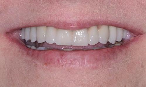gum disease treatment | prosthodontist doylestown pa