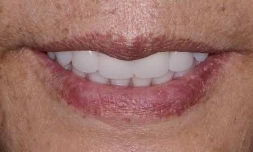 teeth with upper denture and lower hybrid | dentist near me doylestown PA