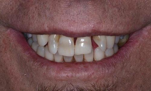 image of teeth with stains & gaps | Doylestown PA