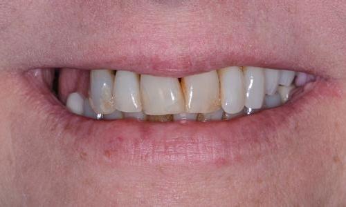 teeth with gum disease | Prosthodontist Doylestown pa