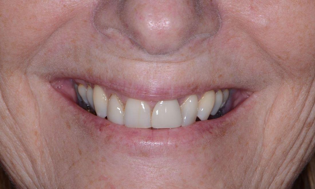 image of teeth with old veneers | Dental Crowns in Doylestown PA