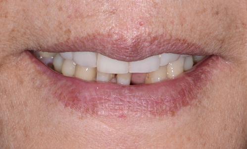 decayed lower teeth | dentist near me doylestown PA