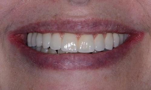 image of the same teeth after a full ceramic bridge and implants | Doylestown PA