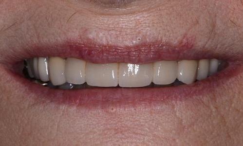 Cosmetic-Restoration-After-Image