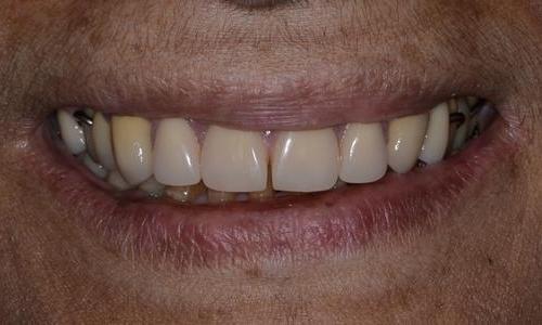 image of the same teeth after crowns and a partial denture | Doylestown PA