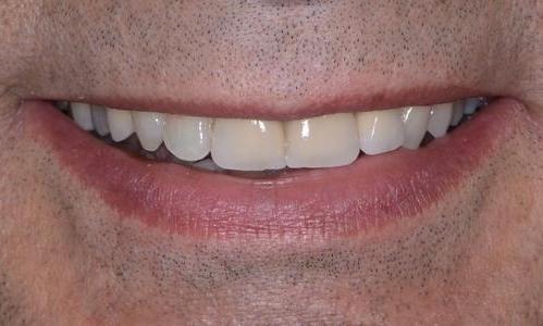image of the same teeth after crowns | Doylestown PA