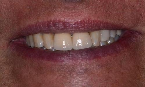 Dental-Implants-and-Crowns-After-Image