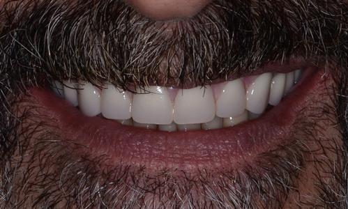 image of the same teeth after an upper over denture | Doylestown PA