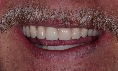 image of the same teeth following an upper over denture | Doylestown PA