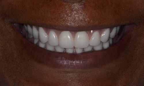 image of new dentures on the same patient | Doylestown PA