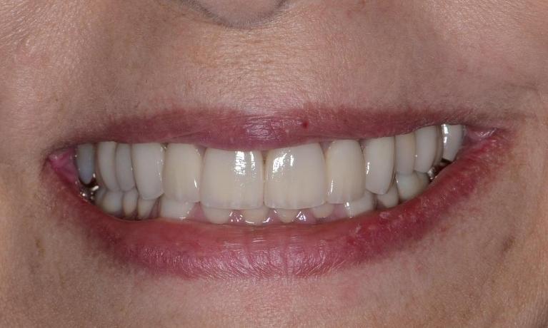 Full-mouth-rehabilitation-in-Doylestown-PA-After-Image