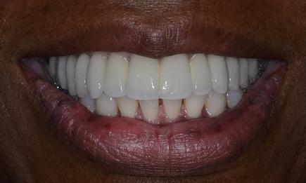 teeth after crowns and dental implants | Doylestown PA