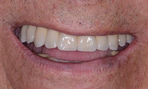image of the same teeth after full upper implants | Doylestown PA