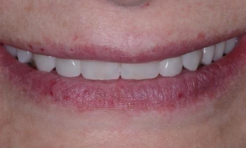 image of the same teeth after crowns and a retainer | Doylestown PA