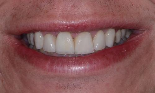 Veneers-After-Image