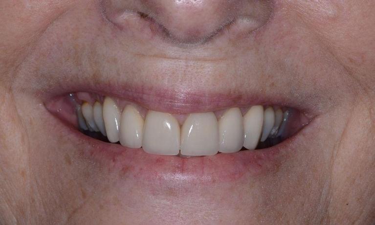 Dental-crowns-After-Image