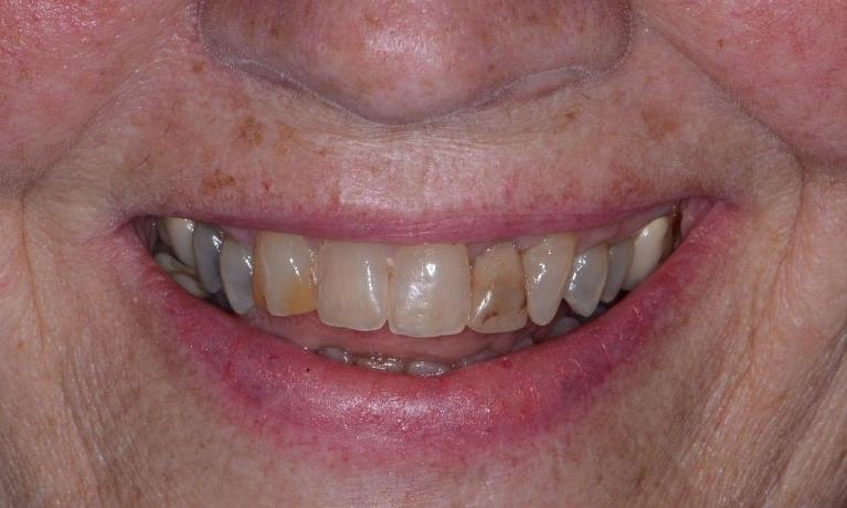 All-Ceramic-Dental-crowns-Before-Image