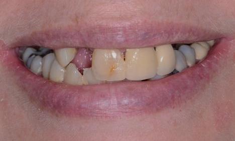 image of teeth with cavities | Doylestown PA