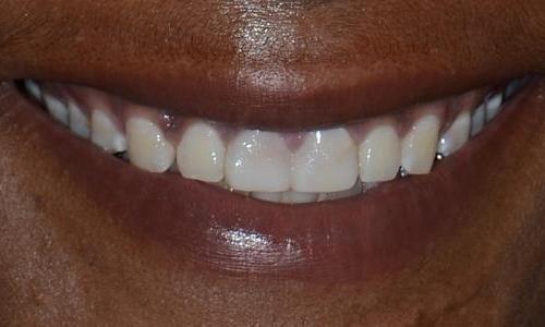 Image of teeth before crowns and bridge | Doylestown PA