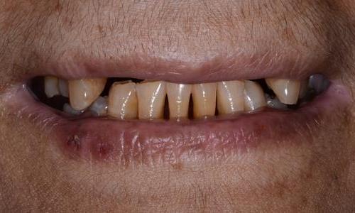 image of missing teeth | Doylestown PA