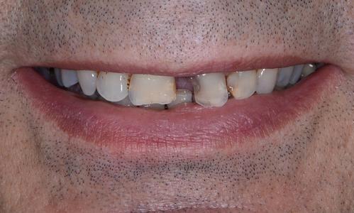 image of chipped teeth with decay | Doylestown PA