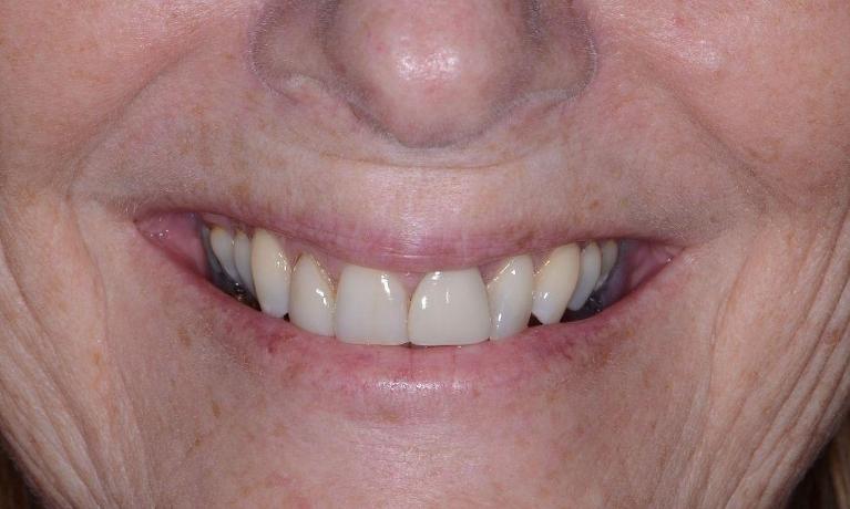 Dental-crowns-Before-Image