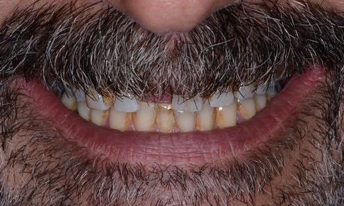 image of discolored undesirable teeth | Doylestown PA