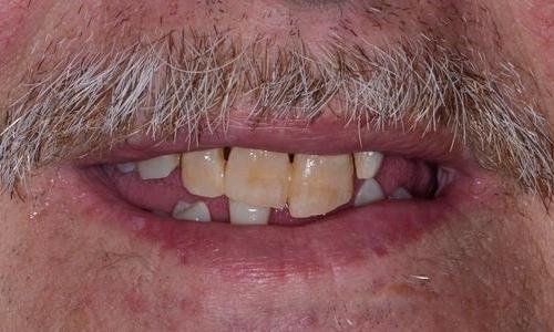 image of teeth with stains and poor shapes | Doylestown PA