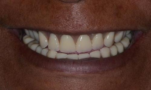 image of old dentures | Doylestown PA