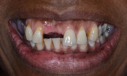 missing and decayed teeth | Doylestown PA