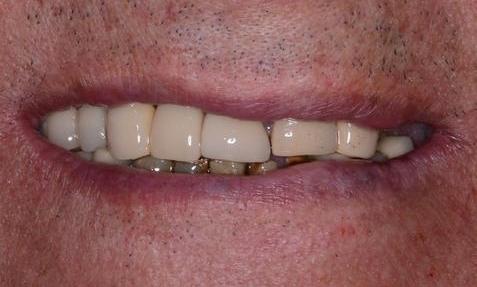 image of a smile with imperfections | Doylestown PA