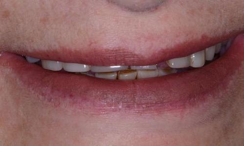 image of teeth with fractures and flares | Doylestown PA