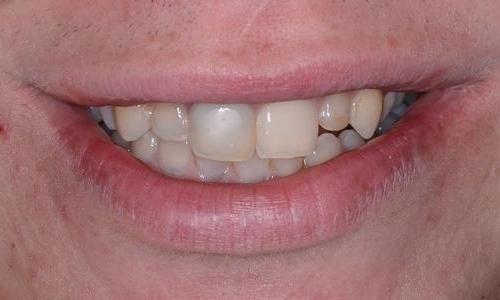 Veneers-Before-Image